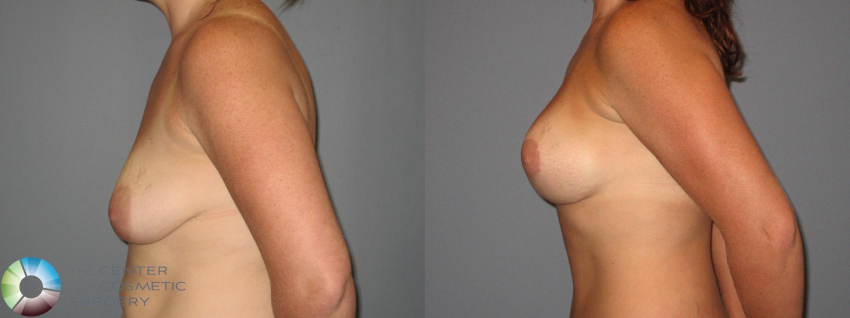 Before & After Mommy Makeover Case 425 View #6 in Denver and Colorado Springs, CO