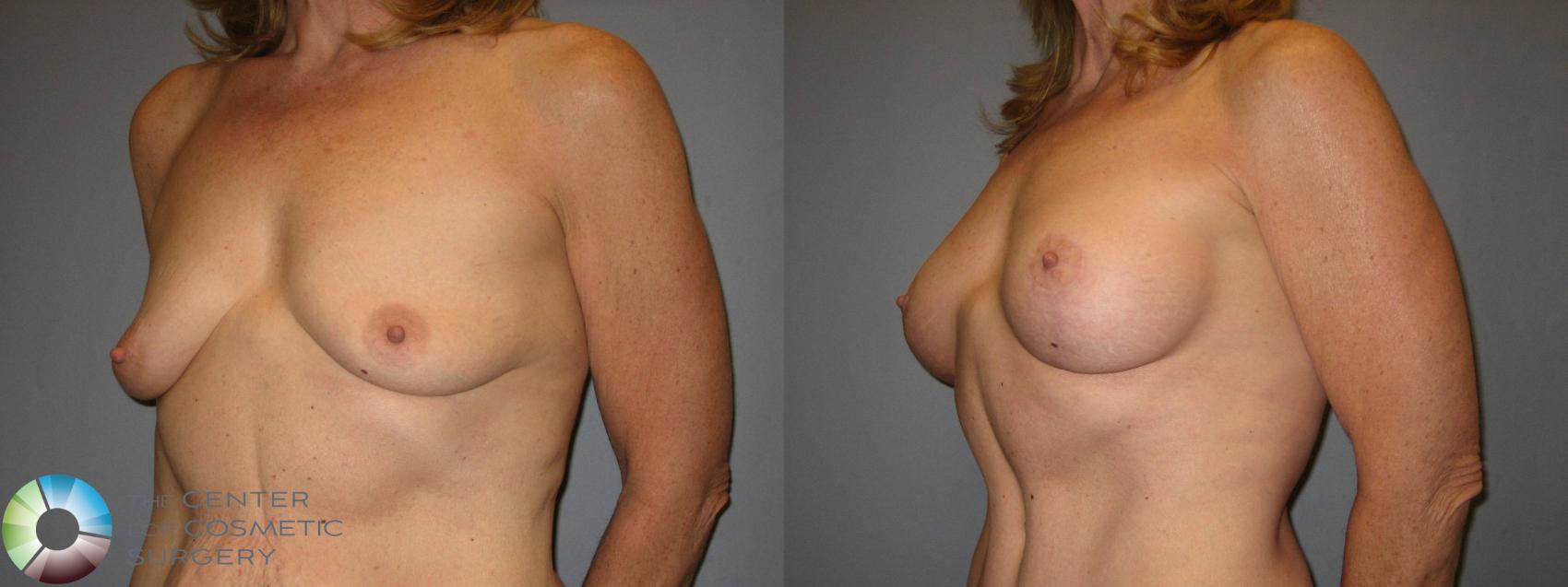 Before & After Power-assisted Liposuction Case 428 View #2 View in Denver & Golden, CO