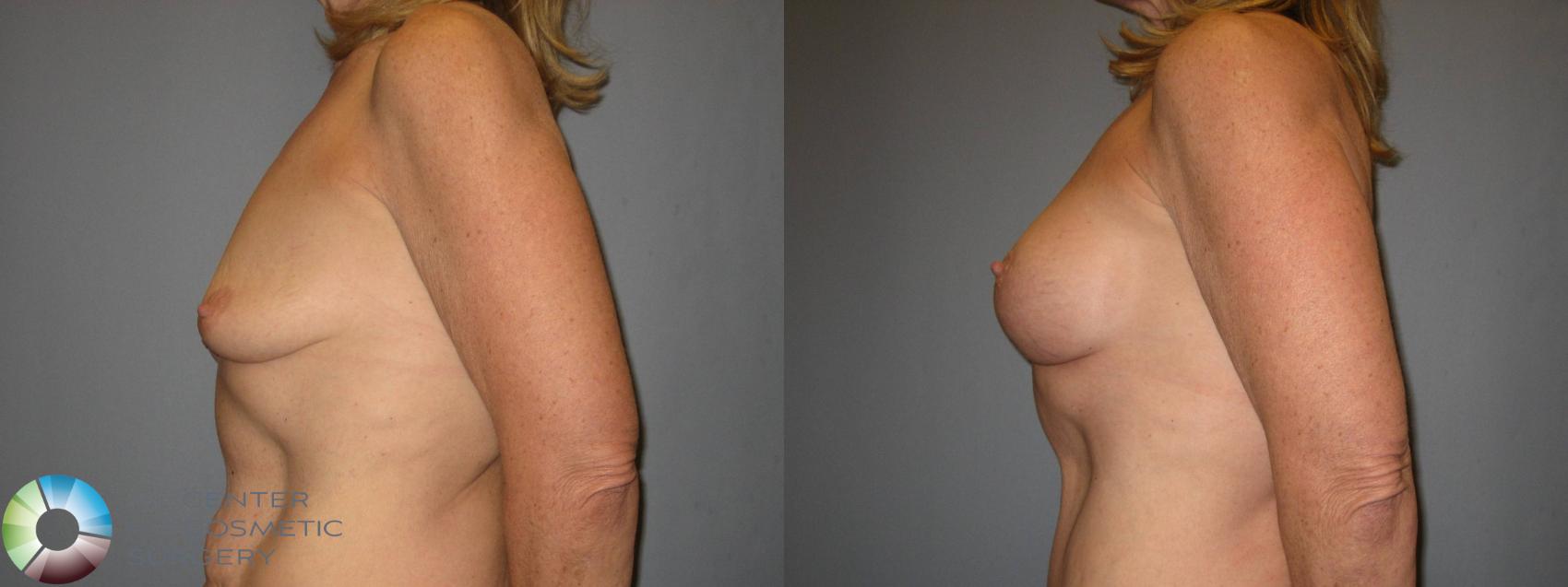 Before & After Power-assisted Liposuction Case 428 View #3 View in Denver & Golden, CO