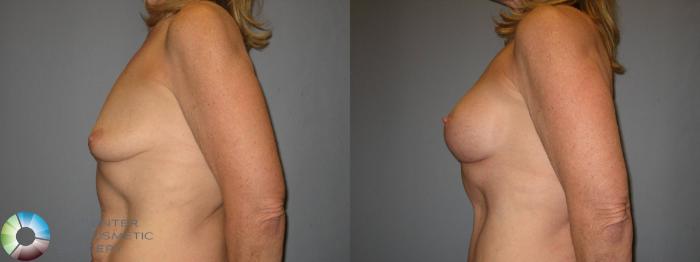 Before & After Power-assisted Liposuction Case 428 View #3 View in Golden, CO