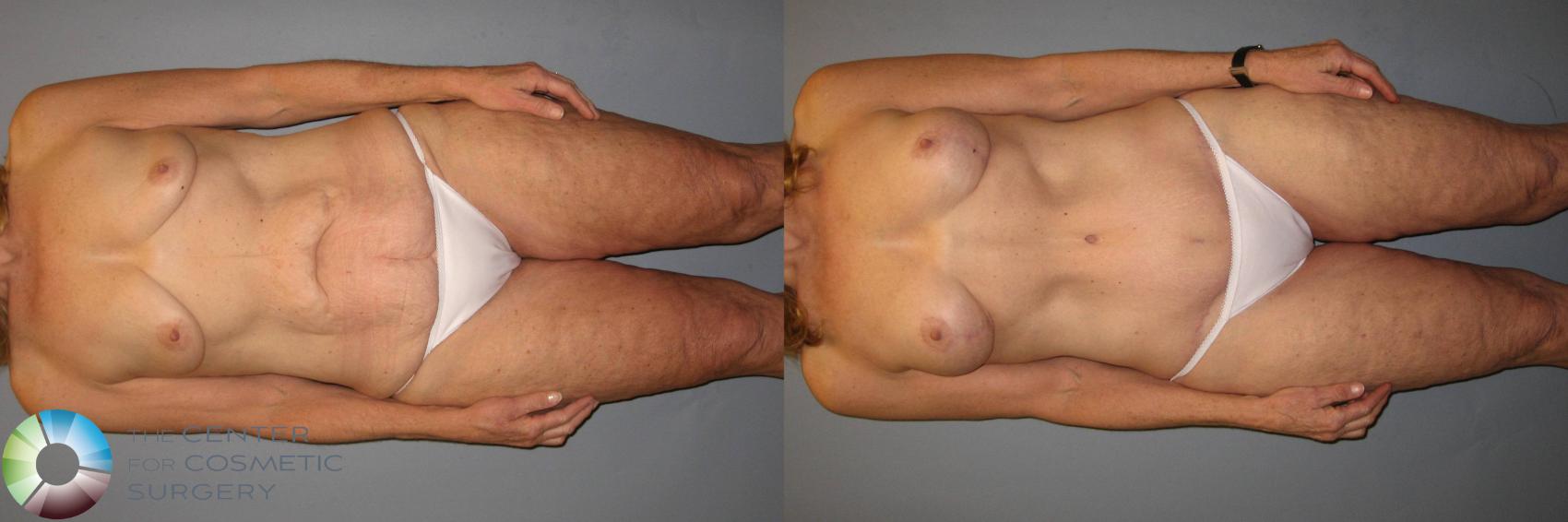 Before & After Power-assisted Liposuction Case 428 View #4 View in Denver & Golden, CO