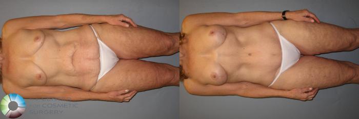 Before & After Power-assisted Liposuction Case 428 View #4 View in Golden, CO