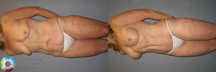 Before & After Power-assisted Liposuction Case 428 View #5 View in Golden, CO
