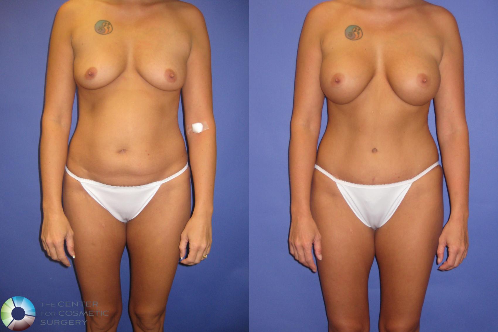 Before & After Breast Augmentation Case 429 View #1 View in Golden, CO