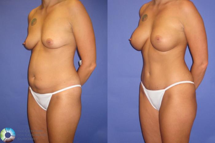 Before & After Tummy Tuck Case 429 View #2 View in Golden, CO