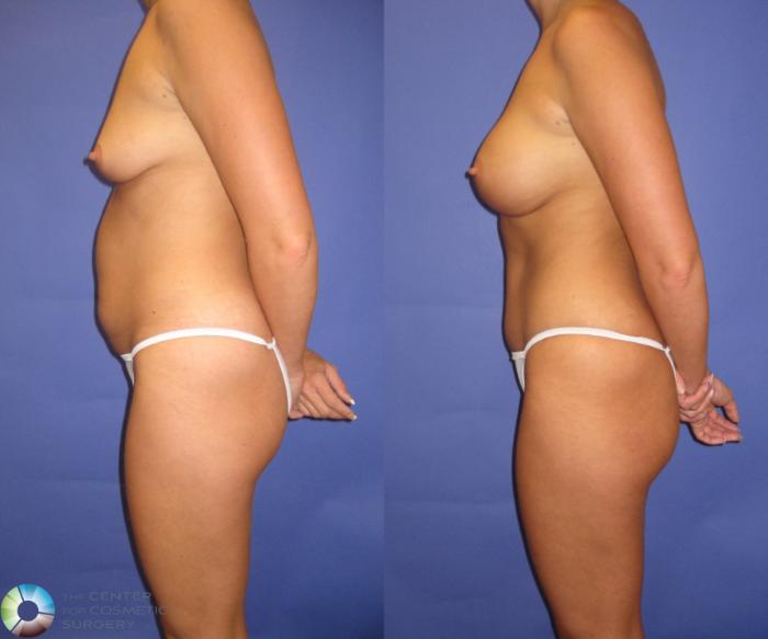 Before & After Tummy Tuck Case 429 View #3 View in Golden, CO