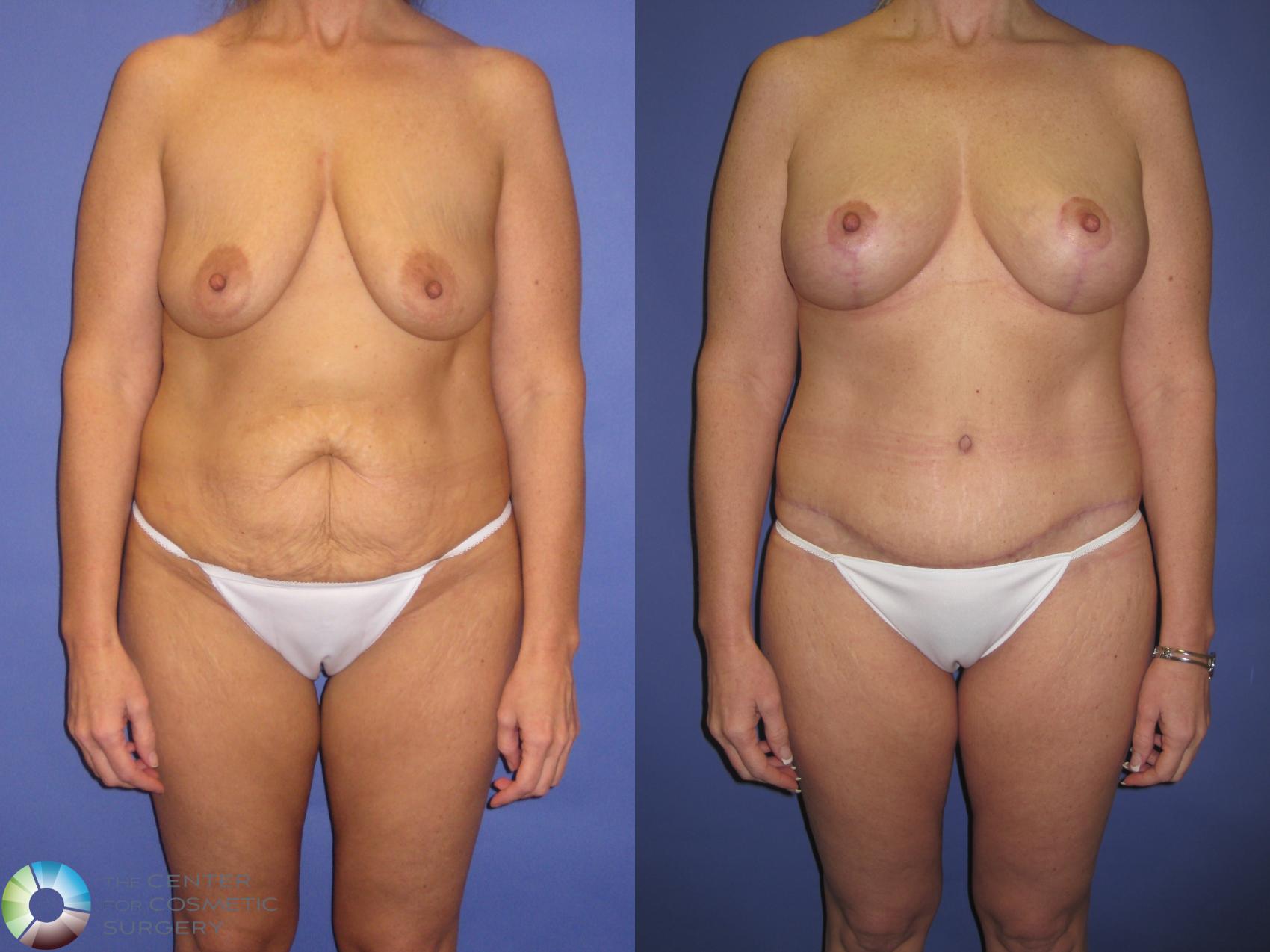 Before & After Power-assisted Liposuction Case 430 View #1 in Denver and Colorado Springs, CO