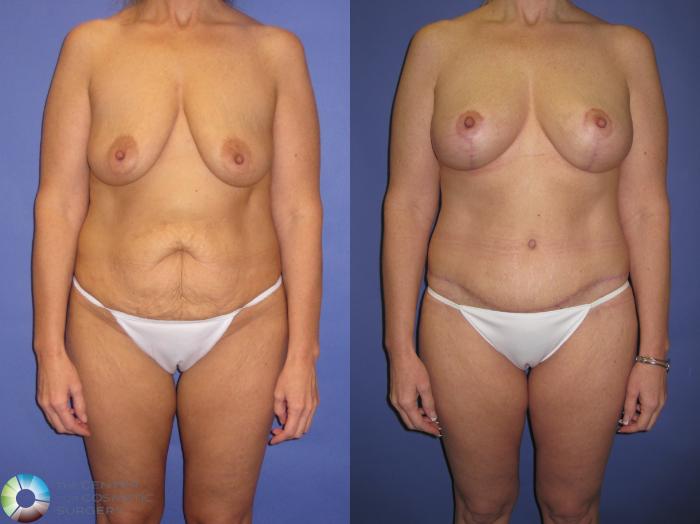 Before & After Breast Augmentation Case 430 View #1 View in Golden, CO