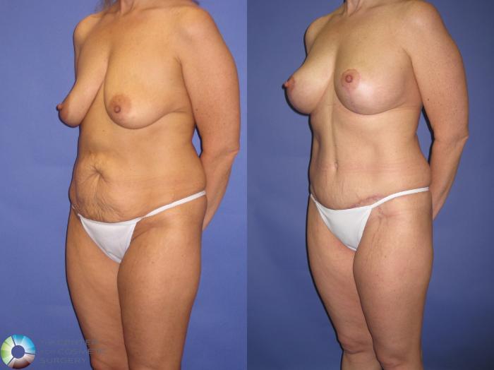 Before & After Breast Augmentation Case 430 View #2 View in Golden, CO