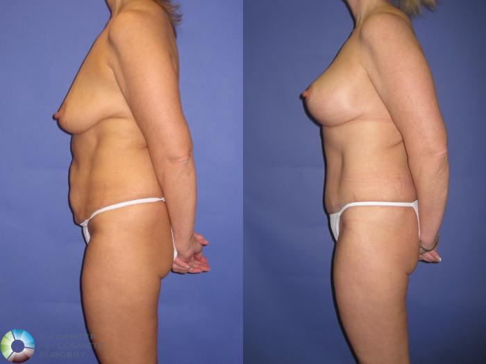 Before & After Breast Augmentation Case 430 View #3 View in Golden, CO