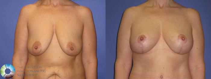 Before & After Breast Augmentation Case 430 View #4 View in Golden, CO