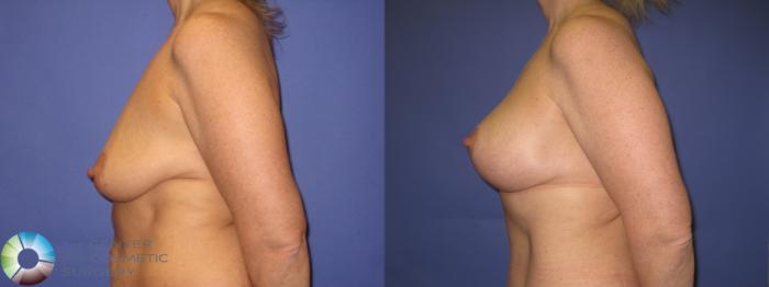 Before & After Breast Augmentation Case 430 View #6 View in Golden, CO