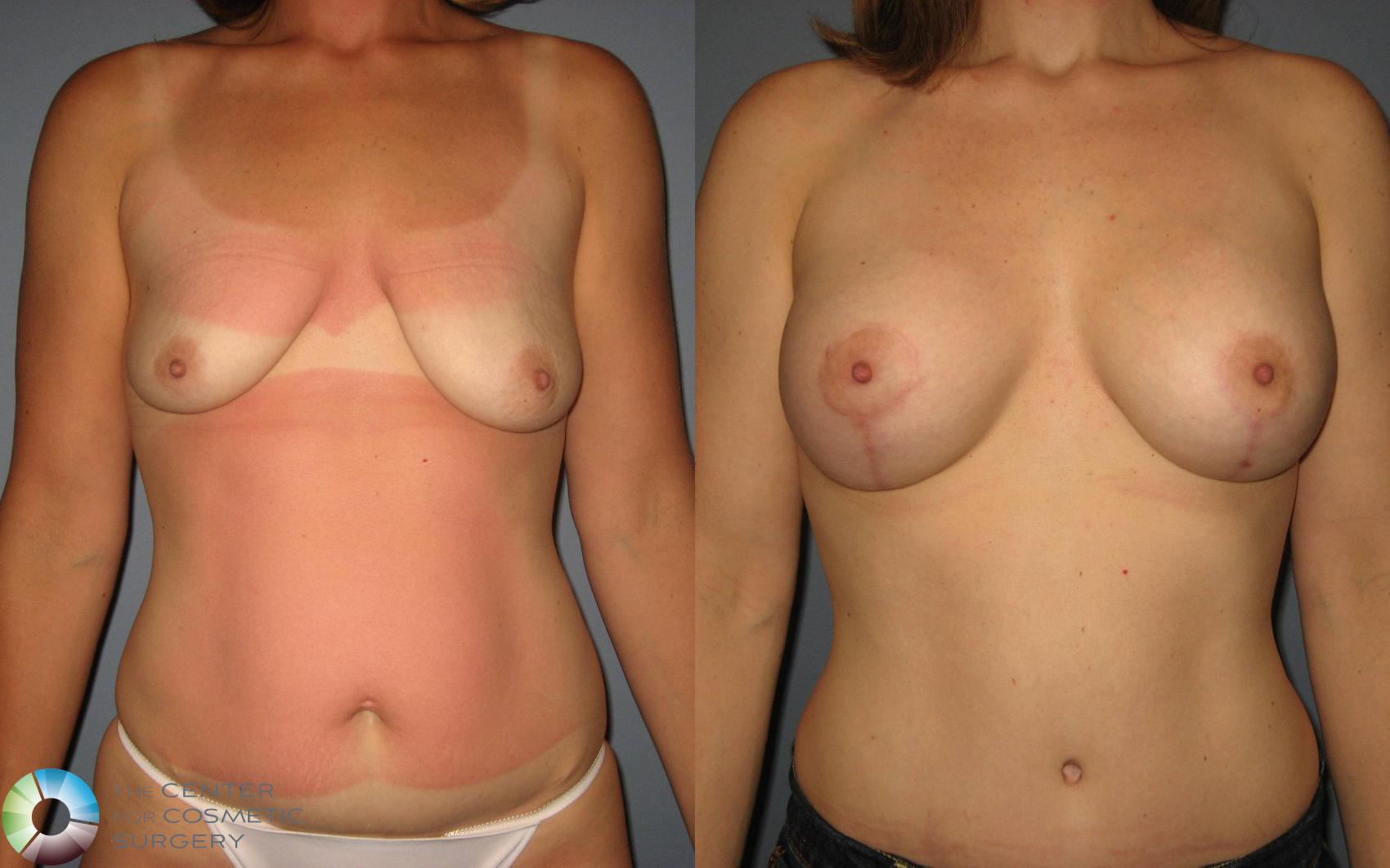Before & After Breast Augmentation Case 431 View #1 View in Golden, CO