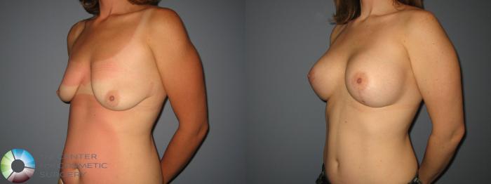 Before & After Breast Augmentation Case 431 View #2 View in Golden, CO