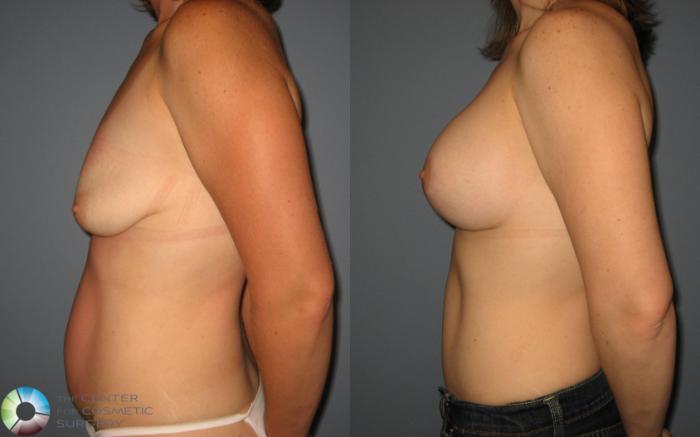 Before & After Breast Augmentation Case 431 View #3 View in Golden, CO