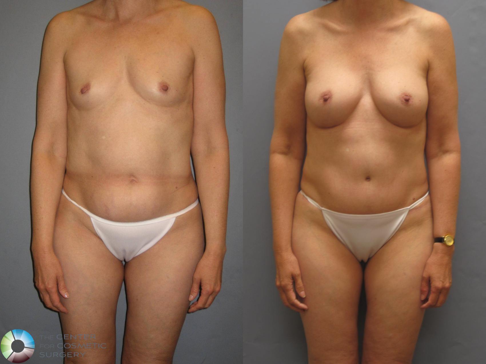 Before & After Breast Augmentation Case 432 View #1 in Denver and Colorado Springs, CO