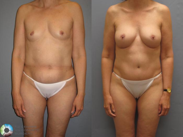 Before & After Breast Augmentation Case 432 View #1 in Denver and Colorado Springs, CO