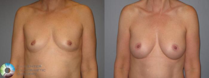 Before & After Breast Augmentation Case 432 View #2 in Denver and Colorado Springs, CO
