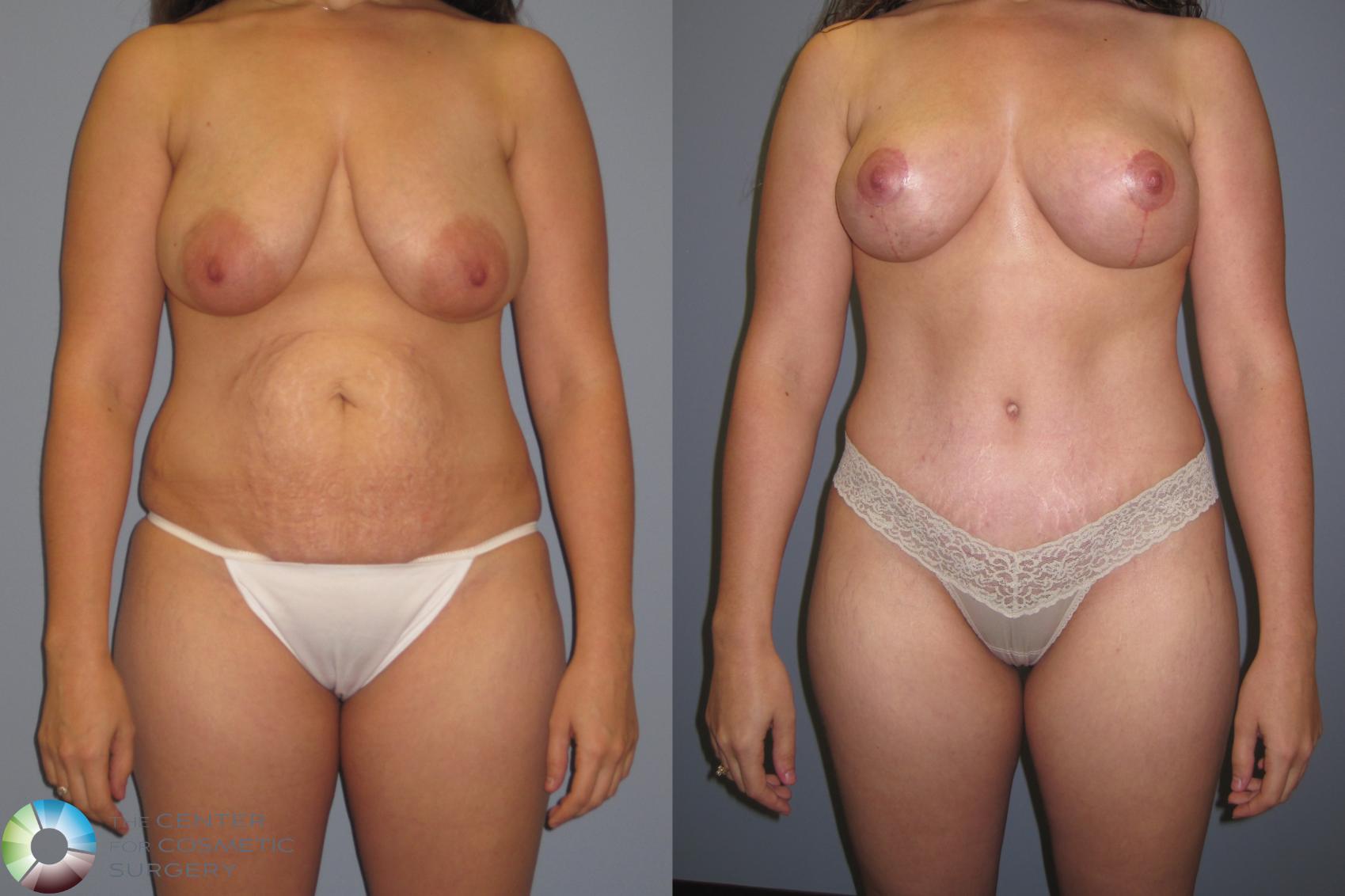 Before & After Tummy Tuck Case 457 View #1 in Denver and Colorado Springs, CO