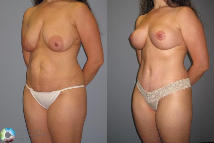 Before & After Breast Reduction Case 457 View #2 View in Golden, CO