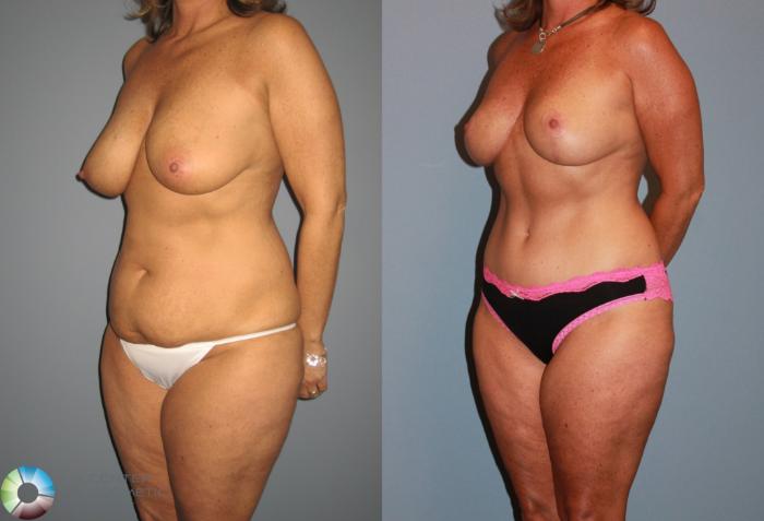Before & After Breast Lift Case 470 View #2 View in Golden, CO