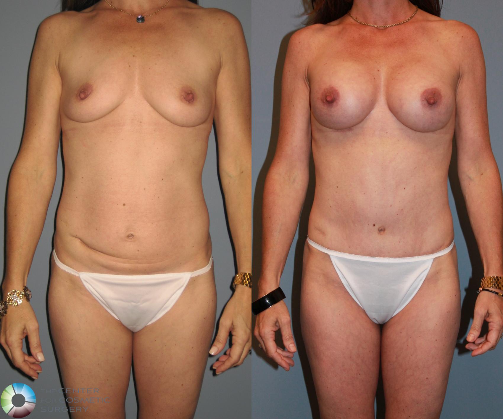Before & After Tummy Tuck Case 475 View #1 View in Golden, CO