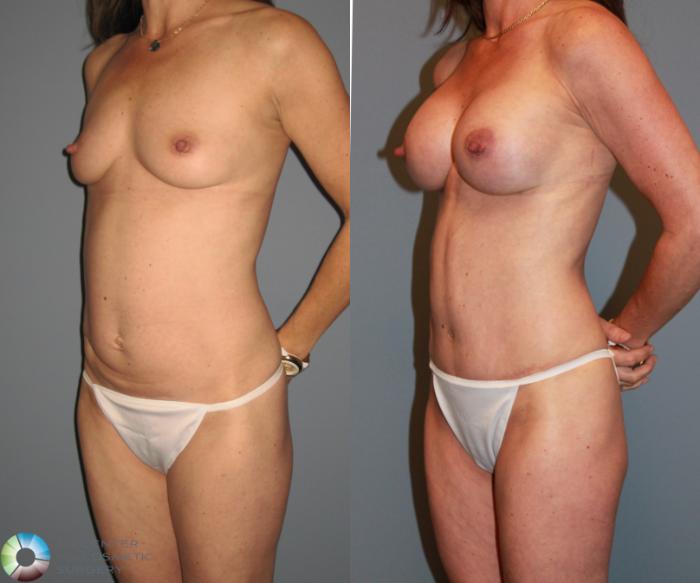 Before & After Tummy Tuck Case 475 View #2 View in Golden, CO