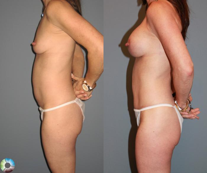 Before & After Tummy Tuck Case 475 View #3 View in Golden, CO