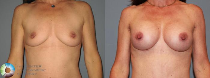 Before & After Tummy Tuck Case 475 View #4 View in Golden, CO