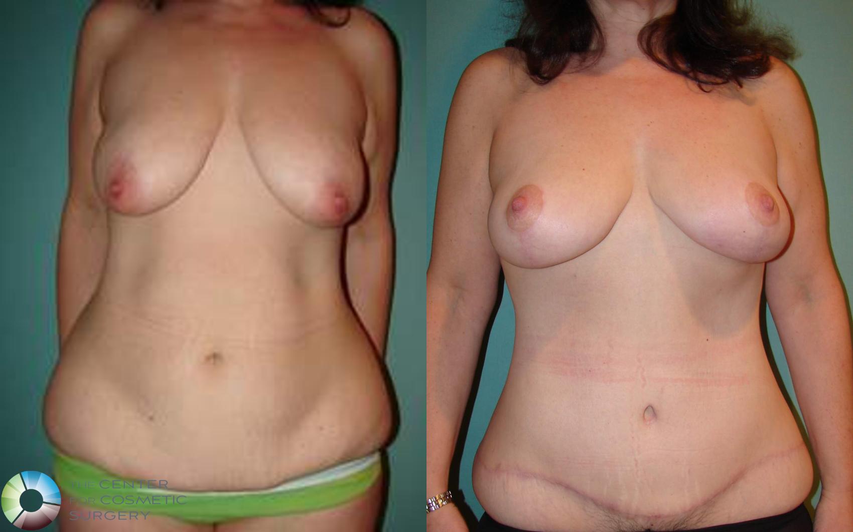 Before & After Mommy Makeover Case 548 View #1 in Denver and Colorado Springs, CO