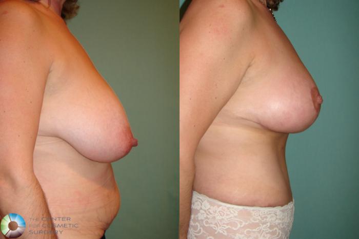 Before & After Mommy Makeover Case 614 Right Lateral View in Golden, CO