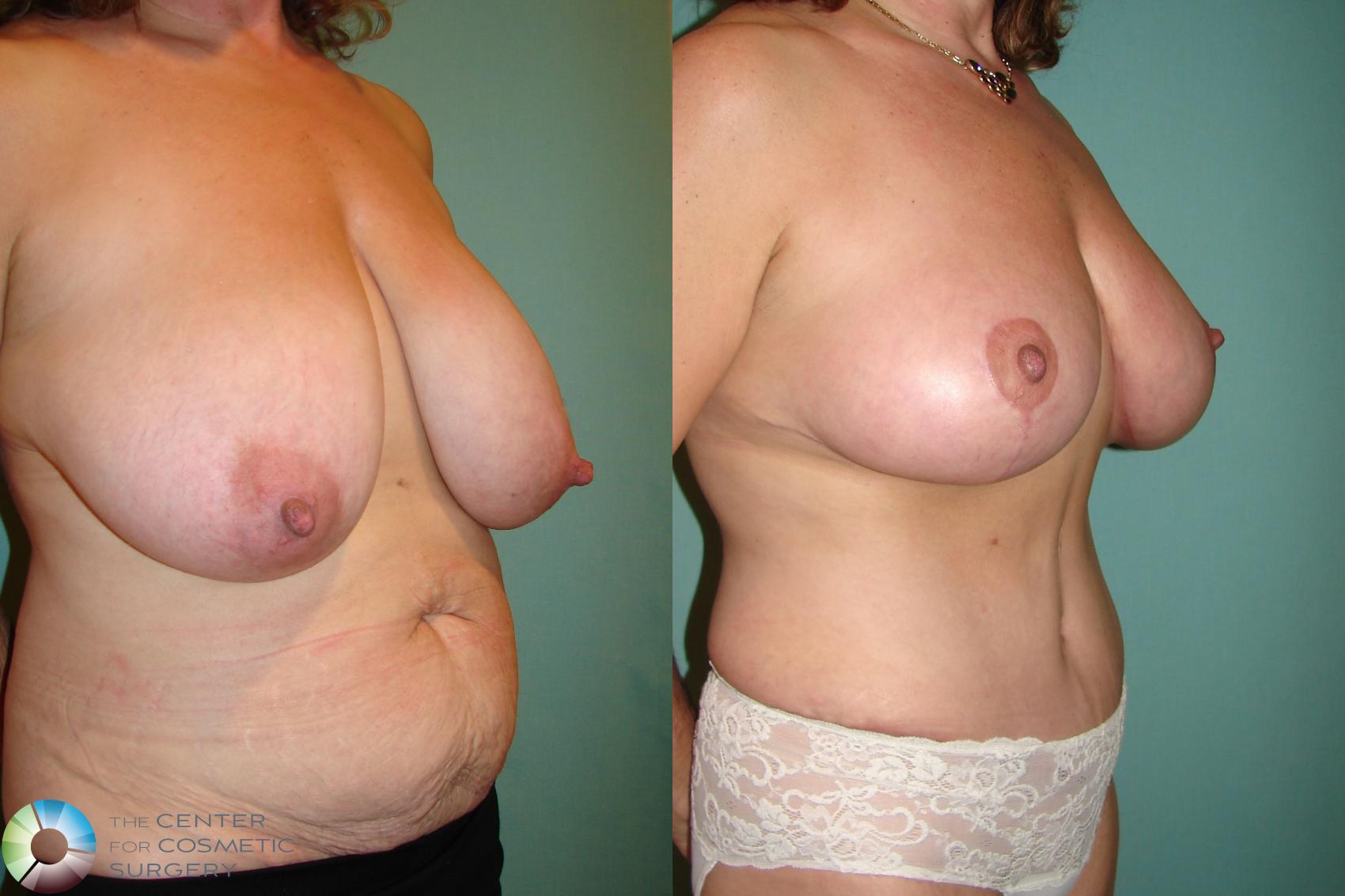 Before & After Mommy Makeover Case 614 Right Oblique in Denver, CO