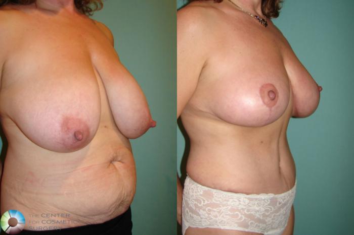 Before & After Mommy Makeover Case 614 Right Oblique View in Golden, CO