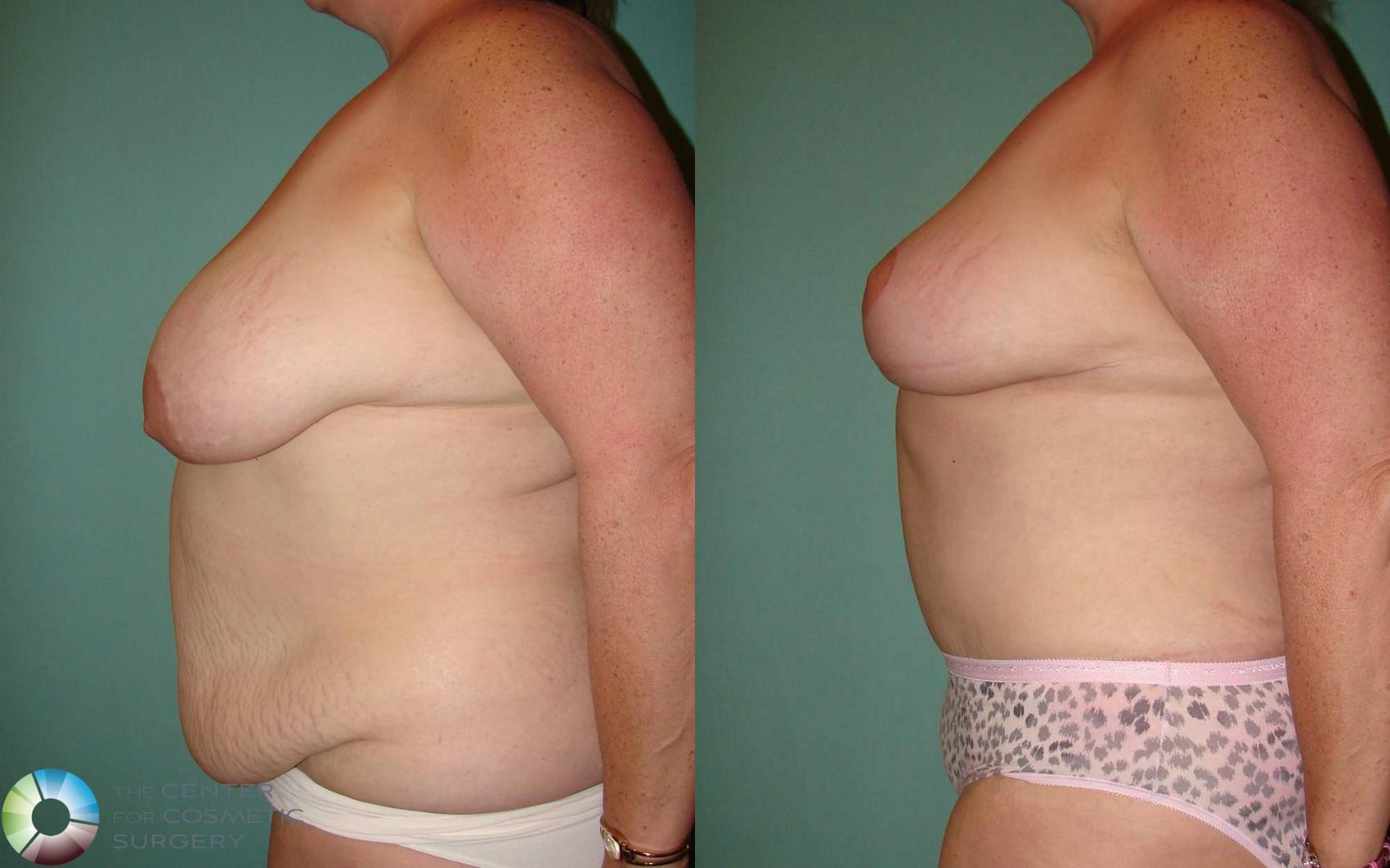 Before & After Mommy Makeover Case 660 View #5 in Denver and Colorado Springs, CO