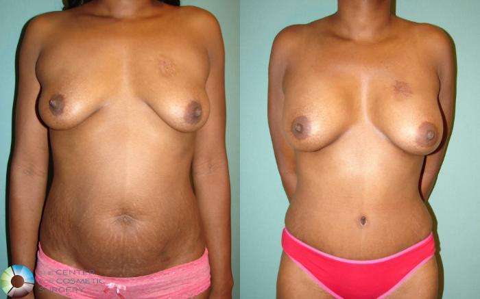 Before & After Mommy Makeover Case 661 View #1 in Denver and Colorado Springs, CO