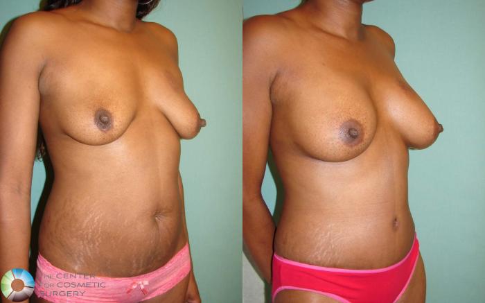 Before & After Mommy Makeover Case 661 View #2 in Denver and Colorado Springs, CO
