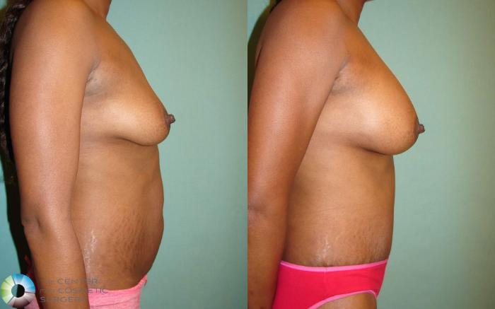 Before & After Mommy Makeover Case 661 View #3 in Denver and Colorado Springs, CO