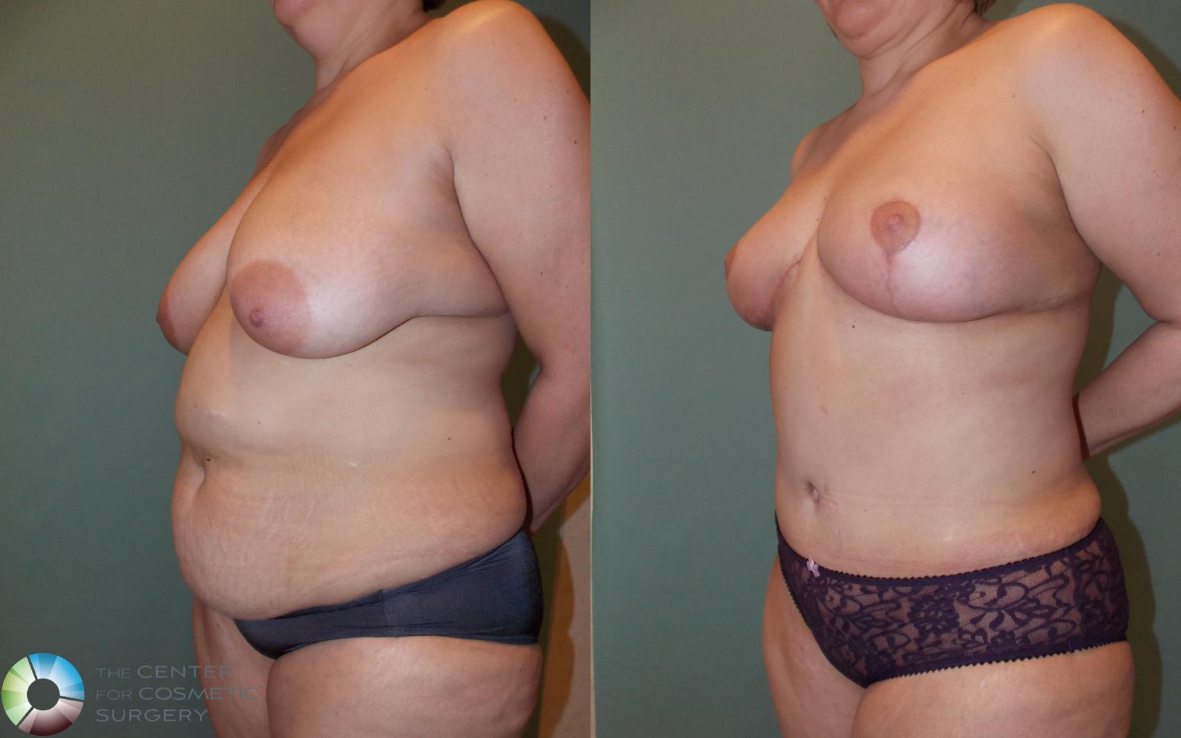 Before & After Mommy Makeover Case 679 View #1 in Denver and Colorado Springs, CO