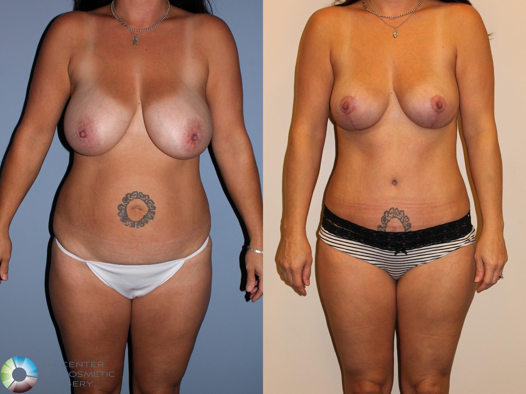 Before & After Tummy Tuck Case 712 View #1 in Denver and Colorado Springs, CO