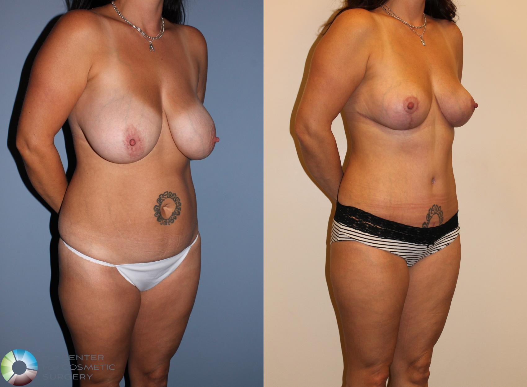 Before & After Breast Lift Case 712 View #2 View in Denver & Golden, CO