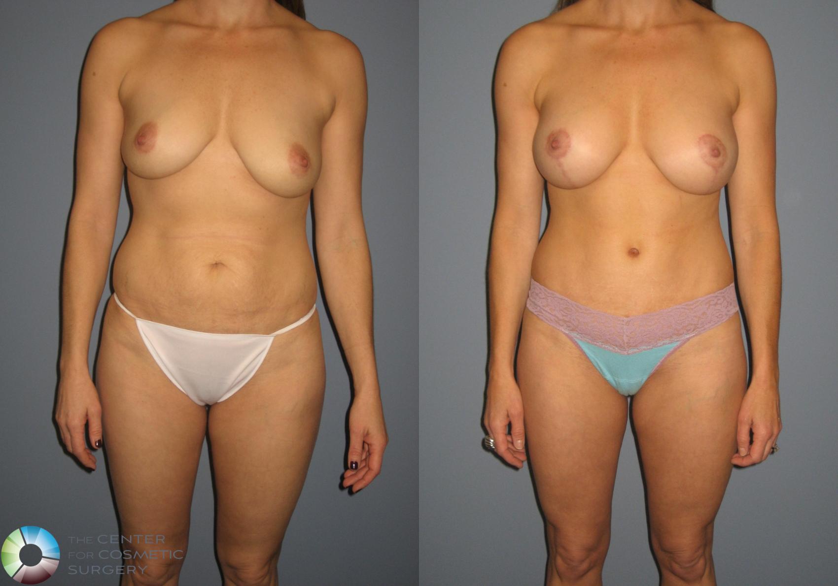 Before & After Tummy Tuck Case 716 View #1 View in Golden, CO