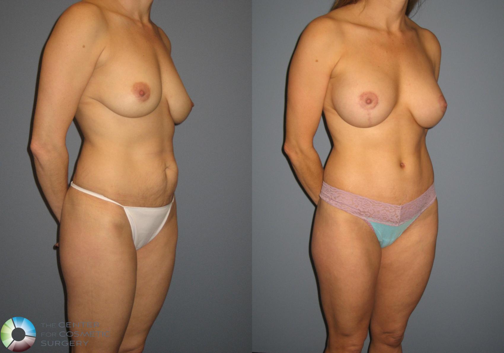 Before & After Mommy Makeover Case 716 View #2 View in Golden, CO