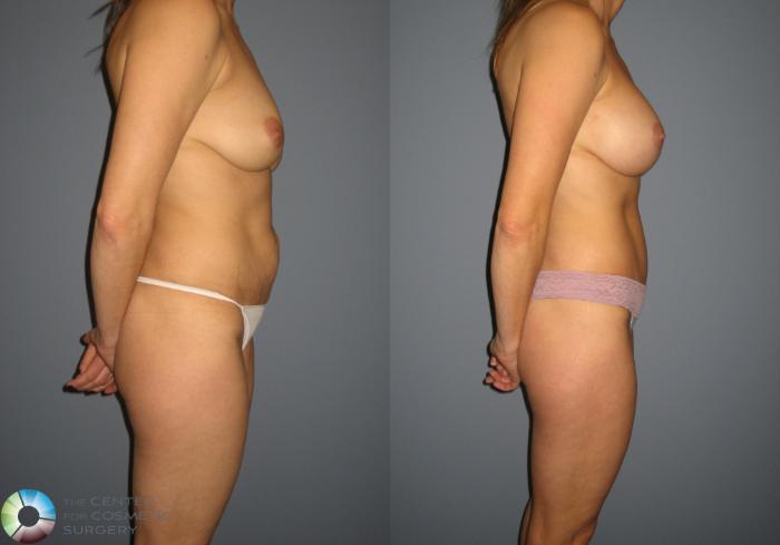 Before & After Tummy Tuck Case 716 View #3 View in Golden, CO