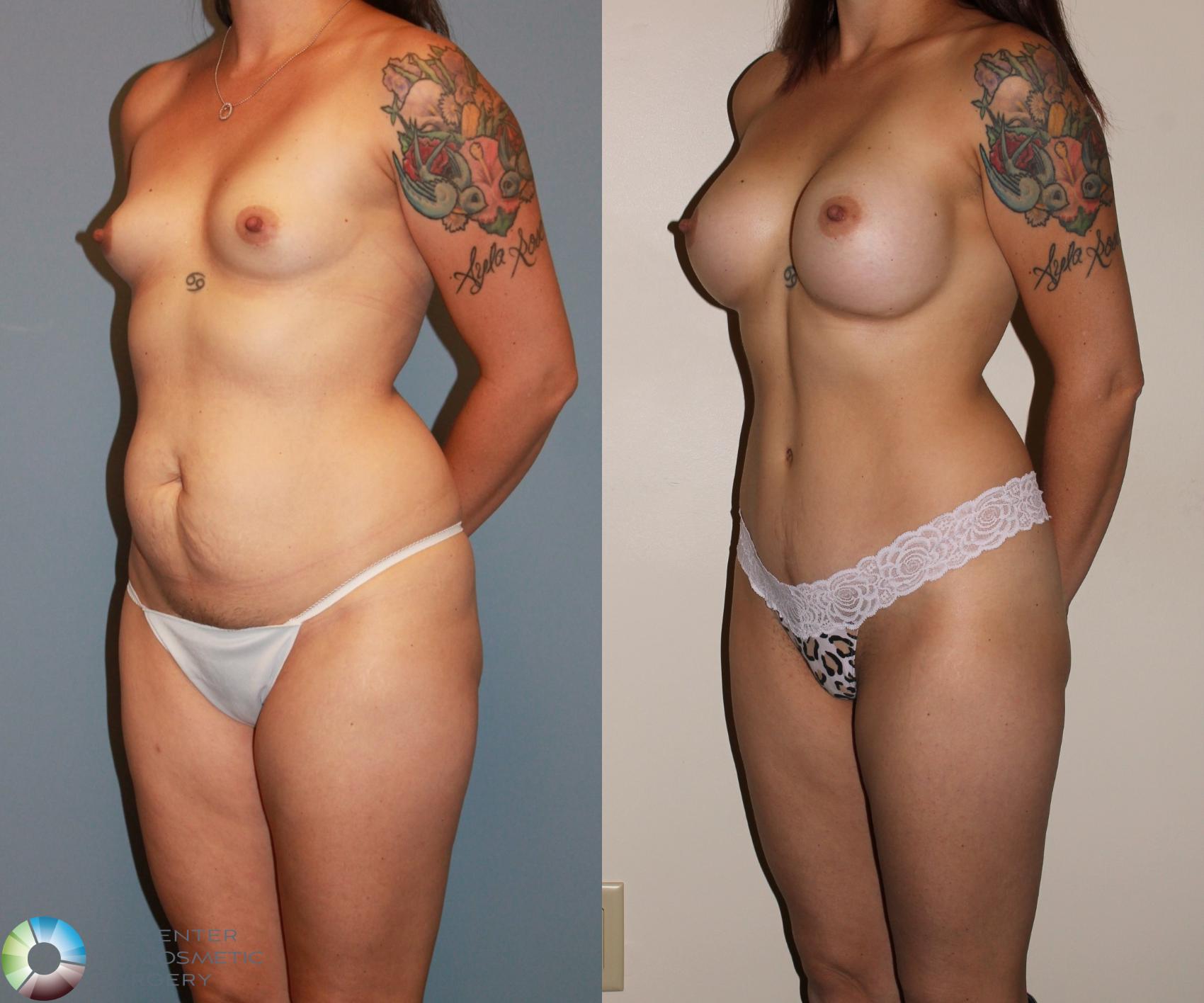 Before & After Tummy Tuck Case 720 View #1 View in Denver & Golden, CO