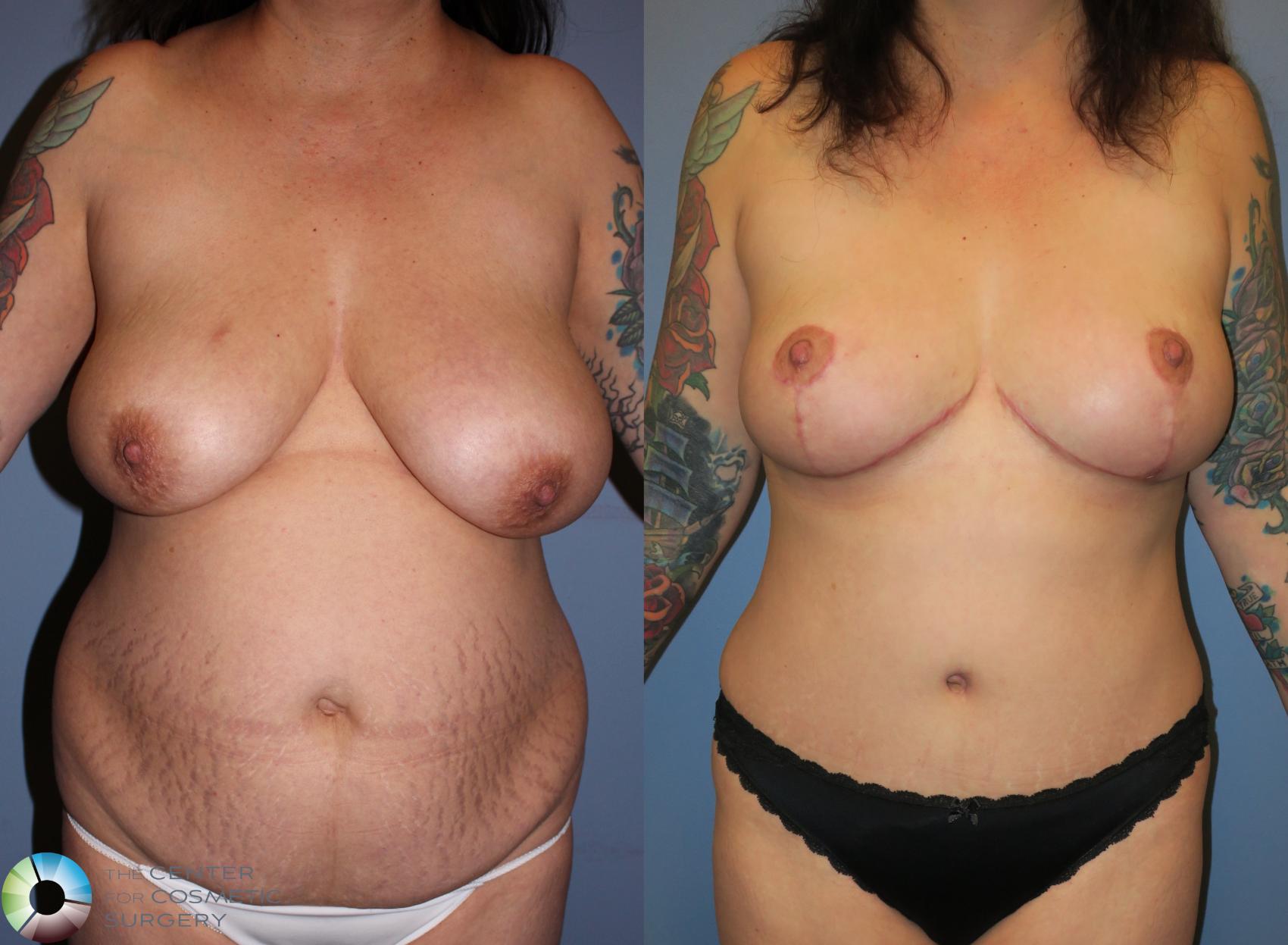 Before & After Breast Reduction Case 777 View #1 in Denver, CO