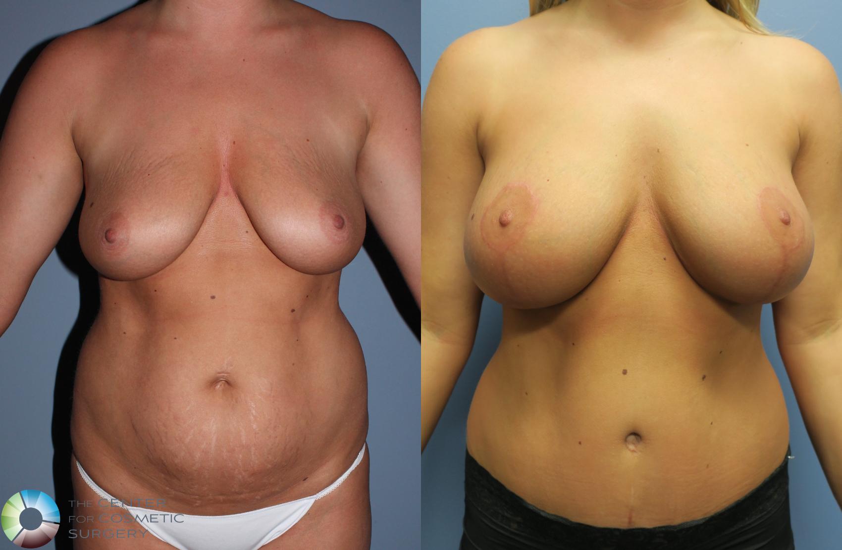 Before & After Mommy Makeover Case 782 View #3 View in Golden, CO