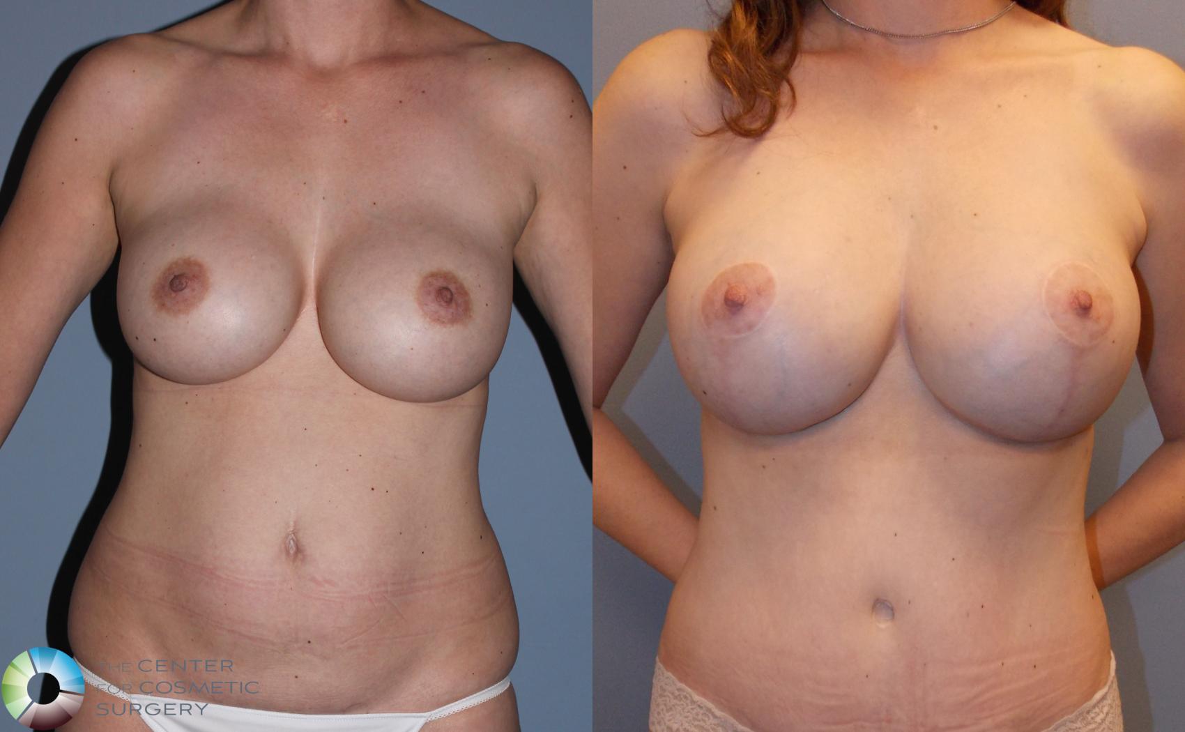 Before & After Mommy Makeover Case 783 View #1 in Denver and Colorado Springs, CO