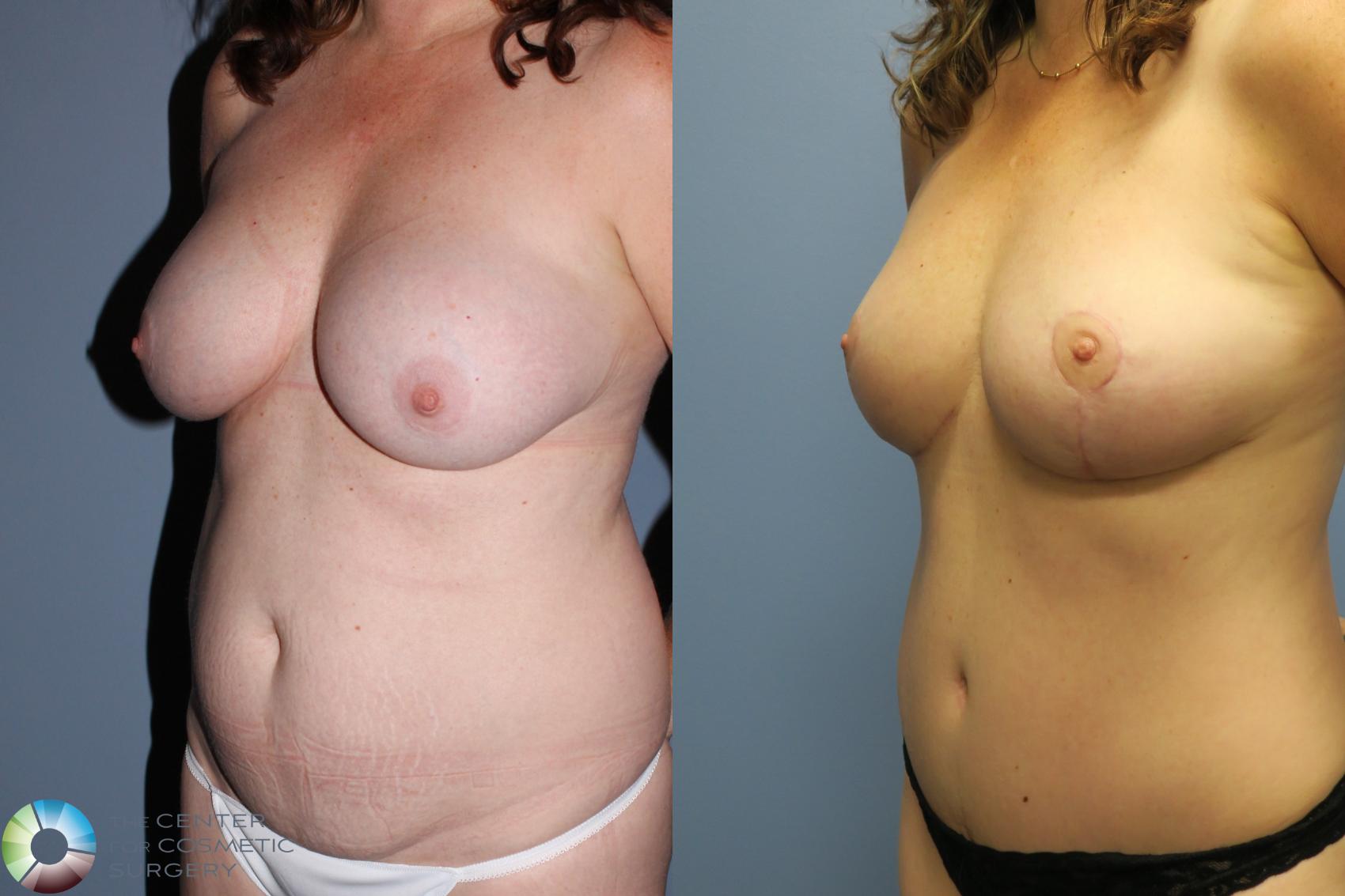 Before & After Mommy Makeover Case 796 Left Oblique in Denver and Colorado Springs, CO