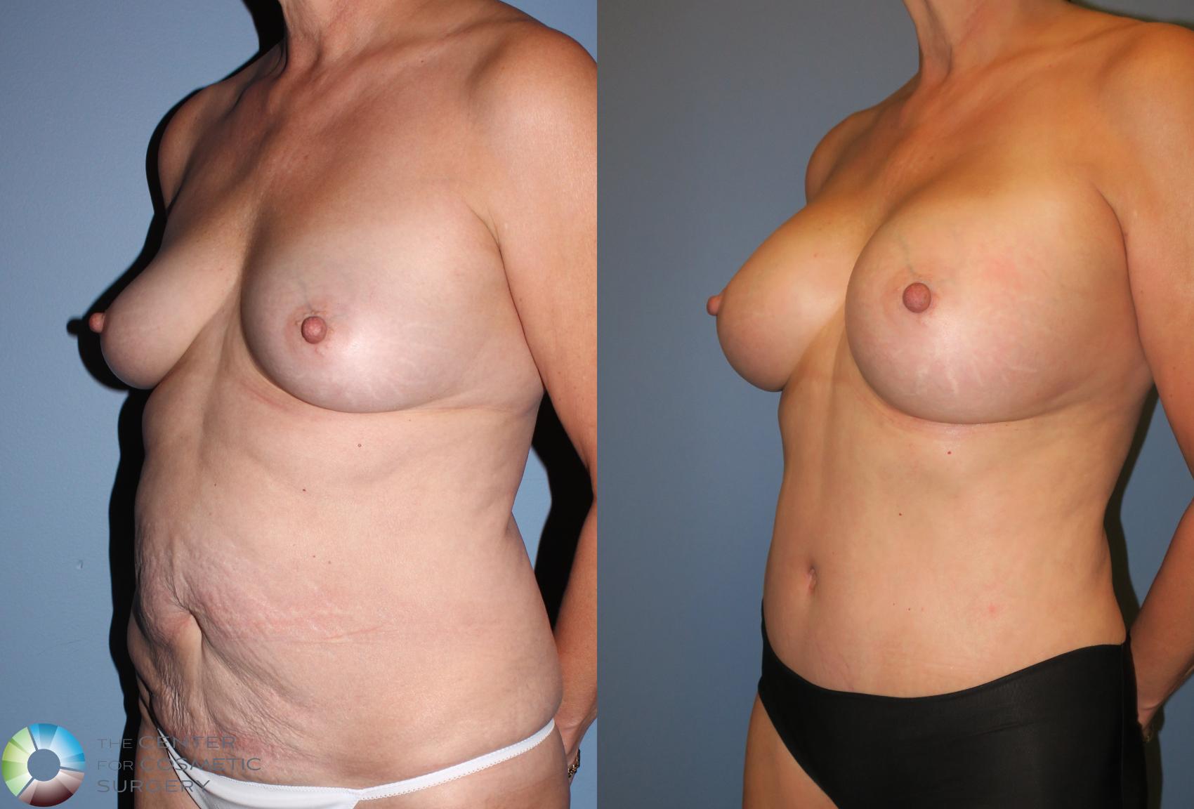 Before & After Mommy Makeover Case 806 View #1 in Denver and Colorado Springs, CO