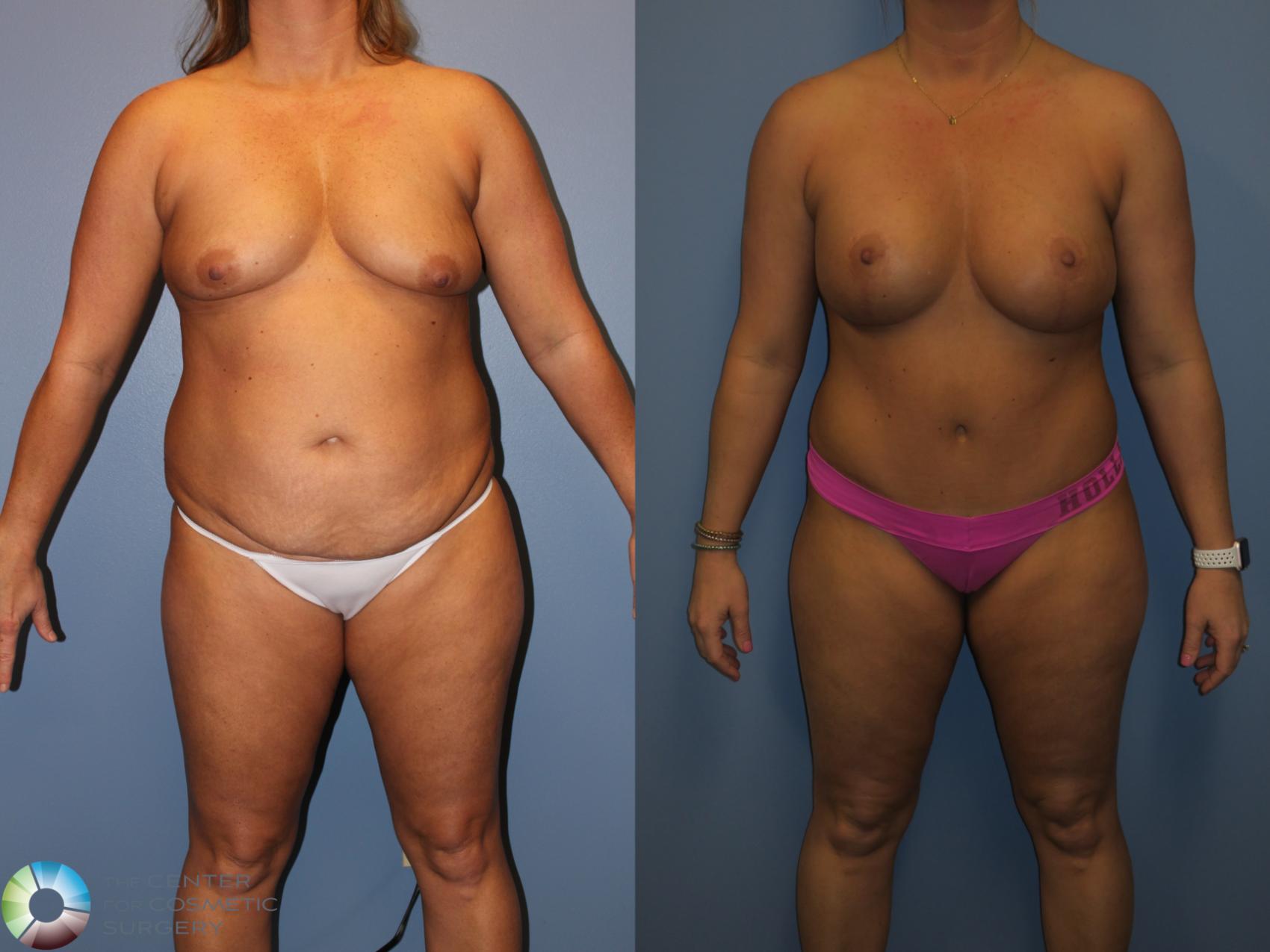 Before & After Power-assisted Liposuction Case 817 View #1 in Denver and Colorado Springs, CO